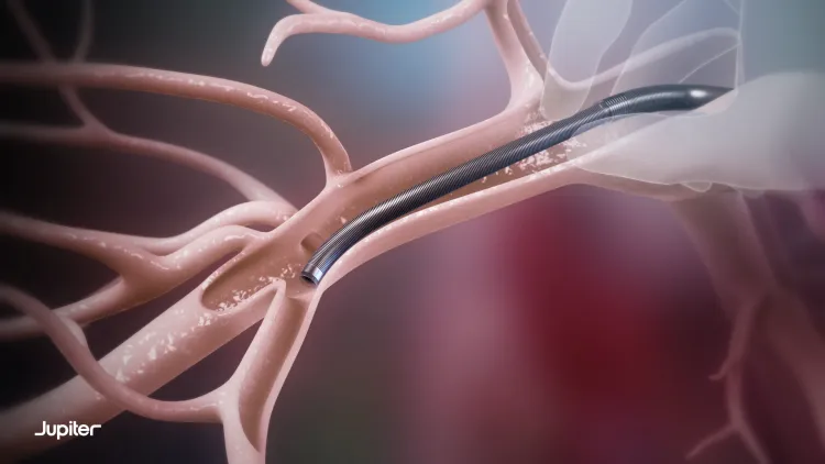 Jupiter Endovascular Announces Positive Results From SPIRARE II Pivotal Trial at EuroPCR 2026