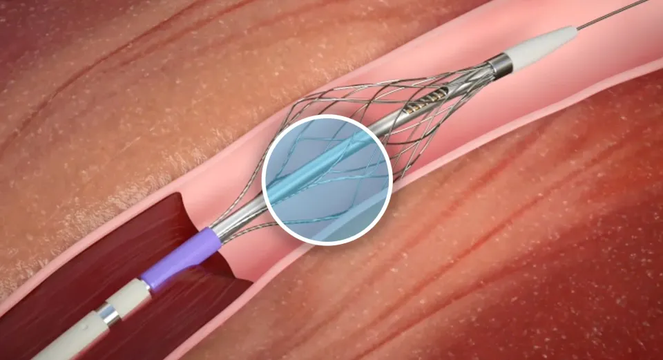 Endologix Acquires Pounce™ Thrombectomy System, Expanding Its Vascular Intervention Portfolio